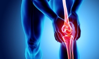 Τα οφέλη της ενέσιμης προλοθεραπείας στην οστεοαρθρίτιδα του γόνατος